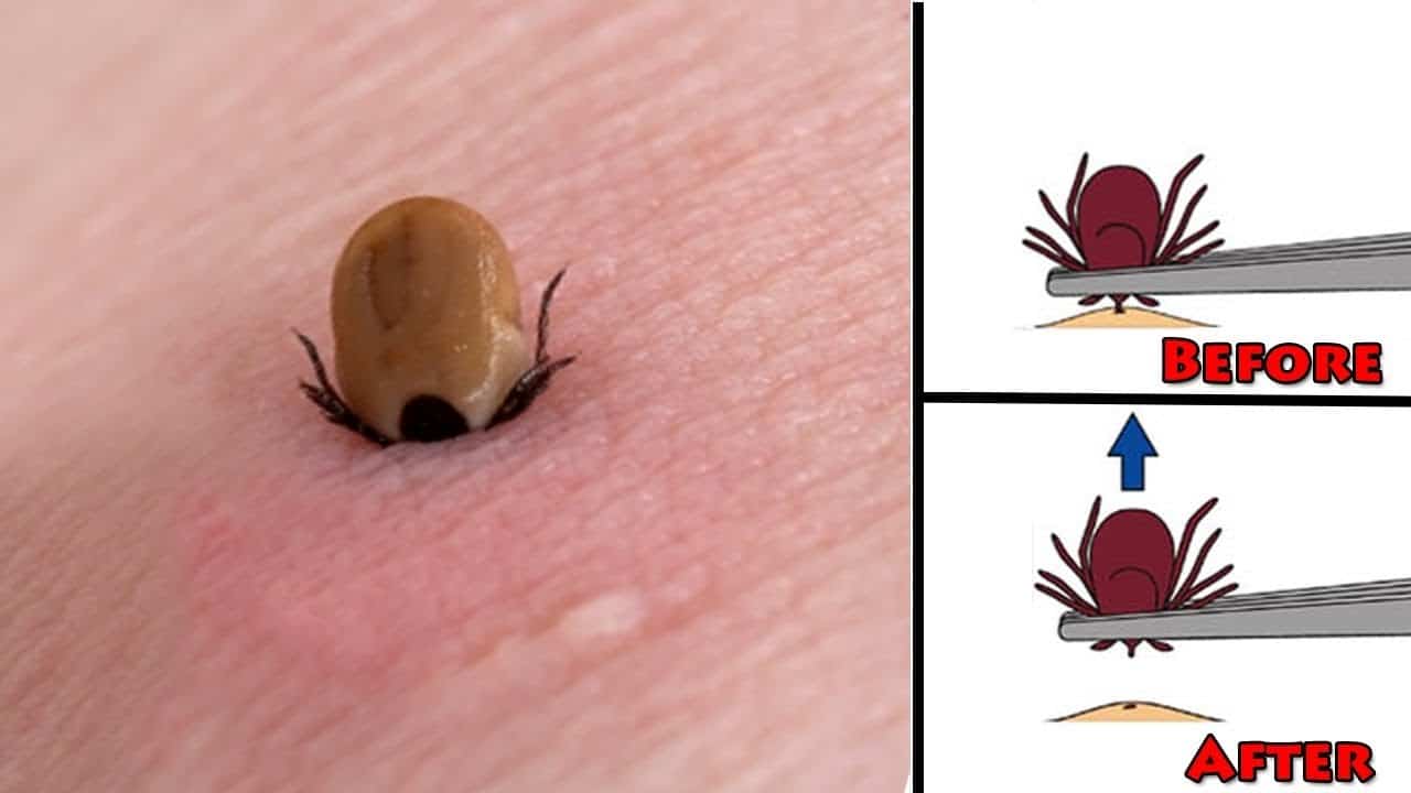 How To Remove Tick Mouthparts Left In Skin