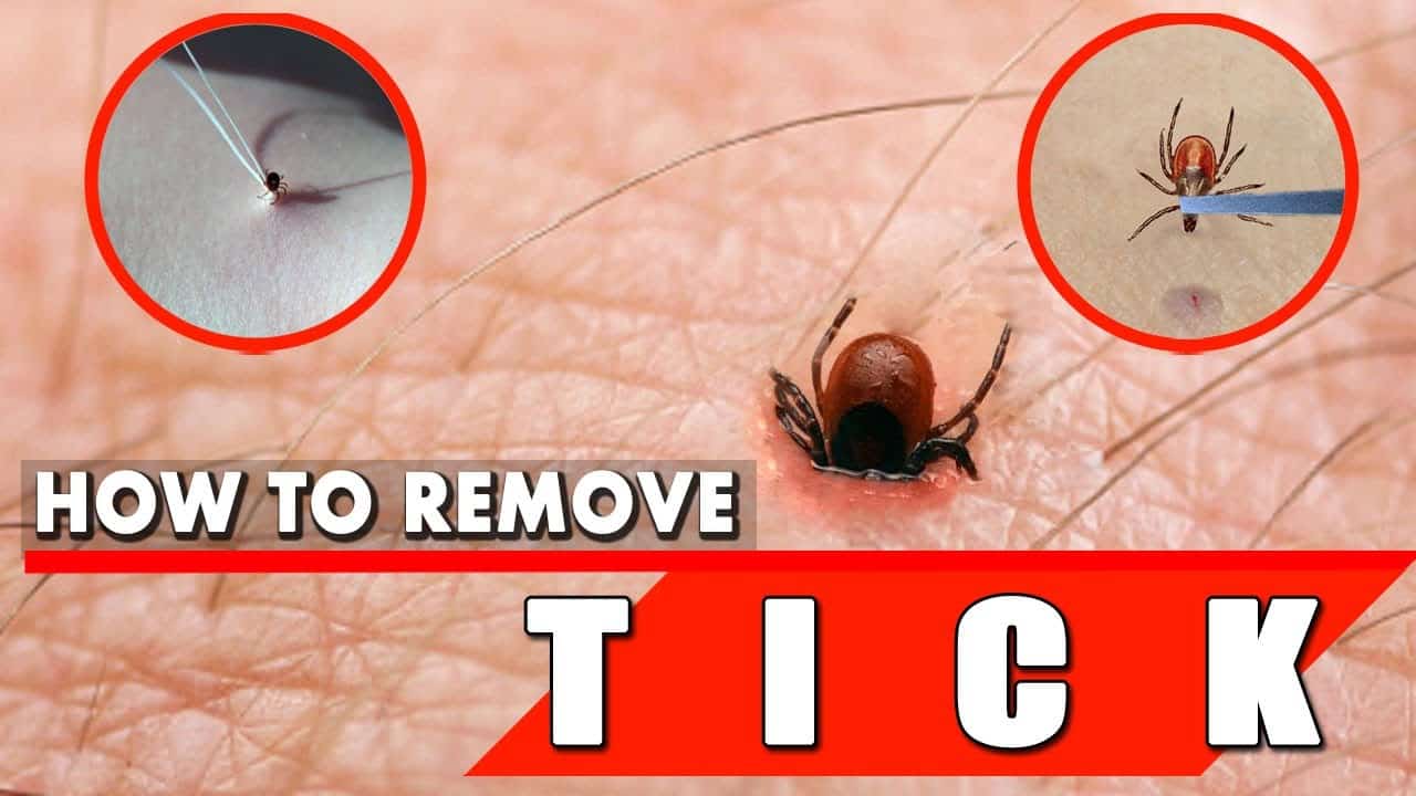 How To Safely Remove a Tick? The Housing Forum